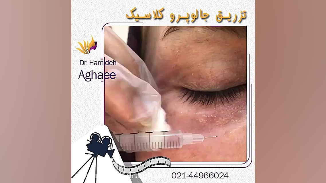 تزریق جالوپرو کلاسیک دکتر حمیده آقایی