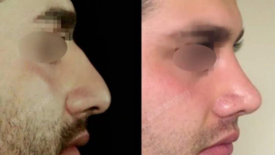 یک سال بعد از جراحی بینی دکتر علی باقری حق