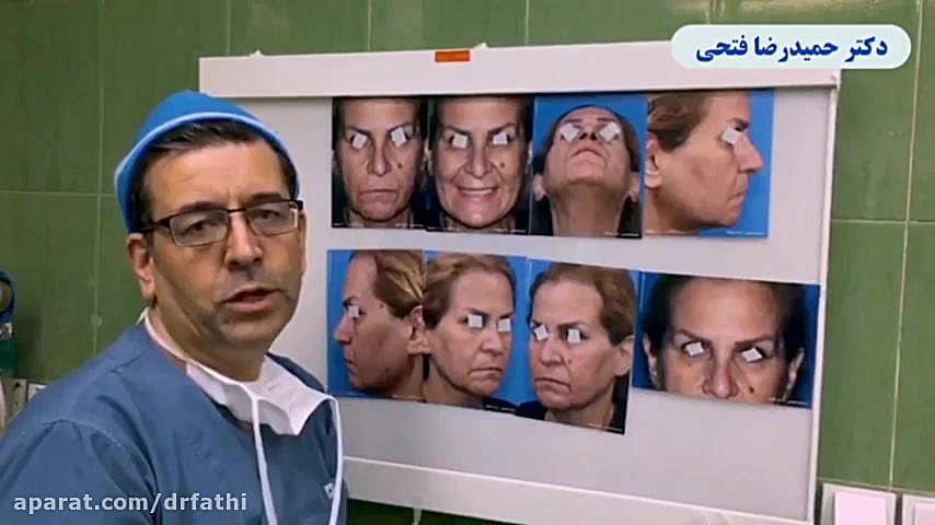 فیلم عمل لیفت صورت به همراه تزریق چربی در خانم 60 ساله مایکروگناتیا
