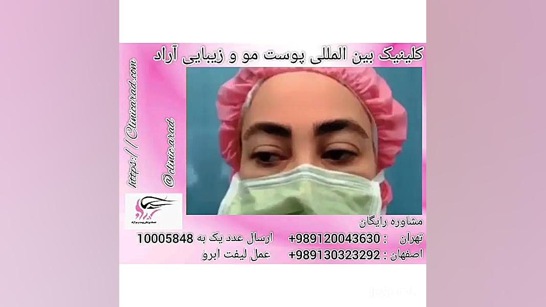 عمل لیفت ابرو کولفی‌تیل