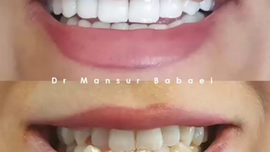 نتیجه انجام لمینت سرامیکی دکتر منصور بابایی