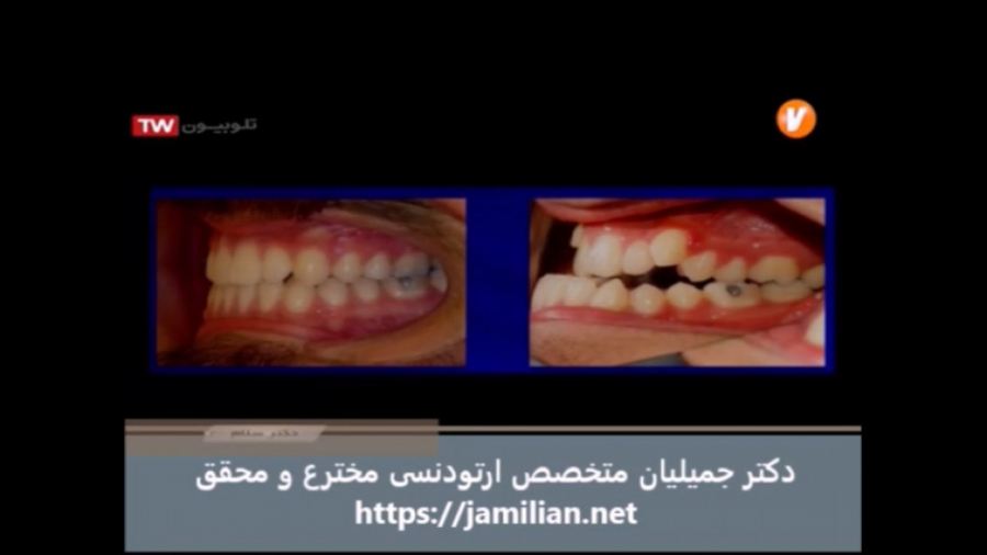 ارتودنسی فکین در بزرگسالان / متخصص ارتودنسی / دکتر جمیلیان دکتر عبدالرضا جمیلیان - متخصص ارتودنسی