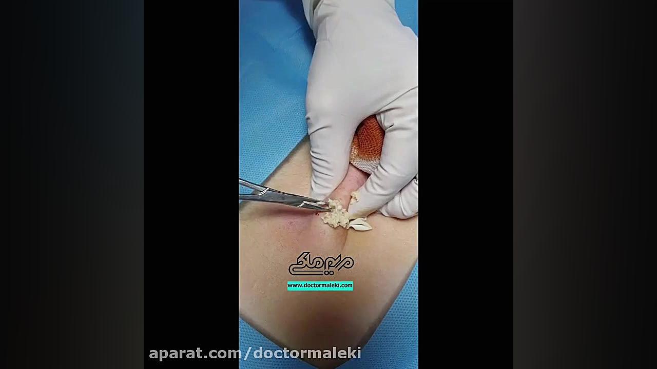 تخلیه کیست اپیدرمال دکتر مریم ملکی - کلینیک پوست و مو و زیبایی هور