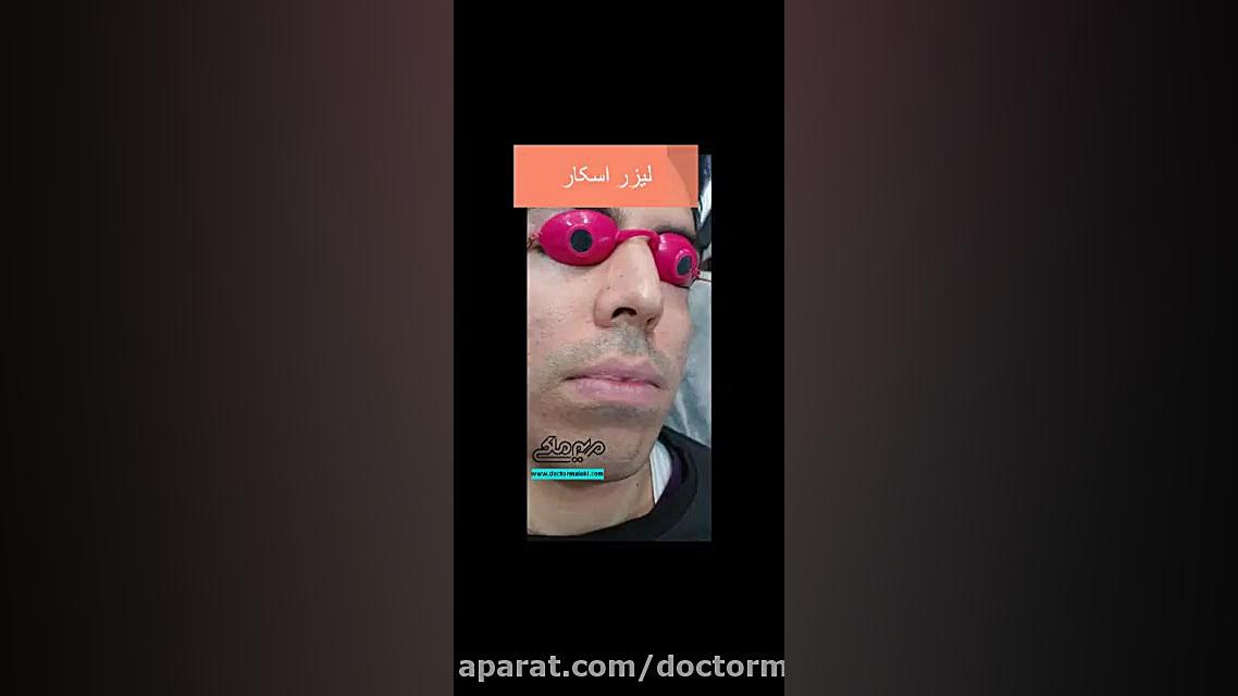 لیزر اسکار دکتر مریم ملکی - کلینیک پوست و مو و زیبایی هور