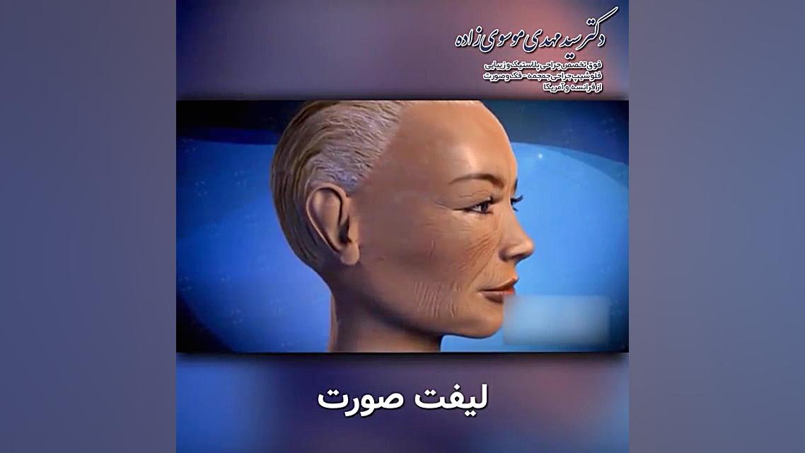 انیمیشن جراحی لیفت صورت بروموکریپتین