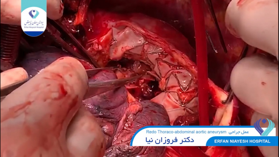 1399.12.10 - Thoraco-abdominal ترمیم ونیر