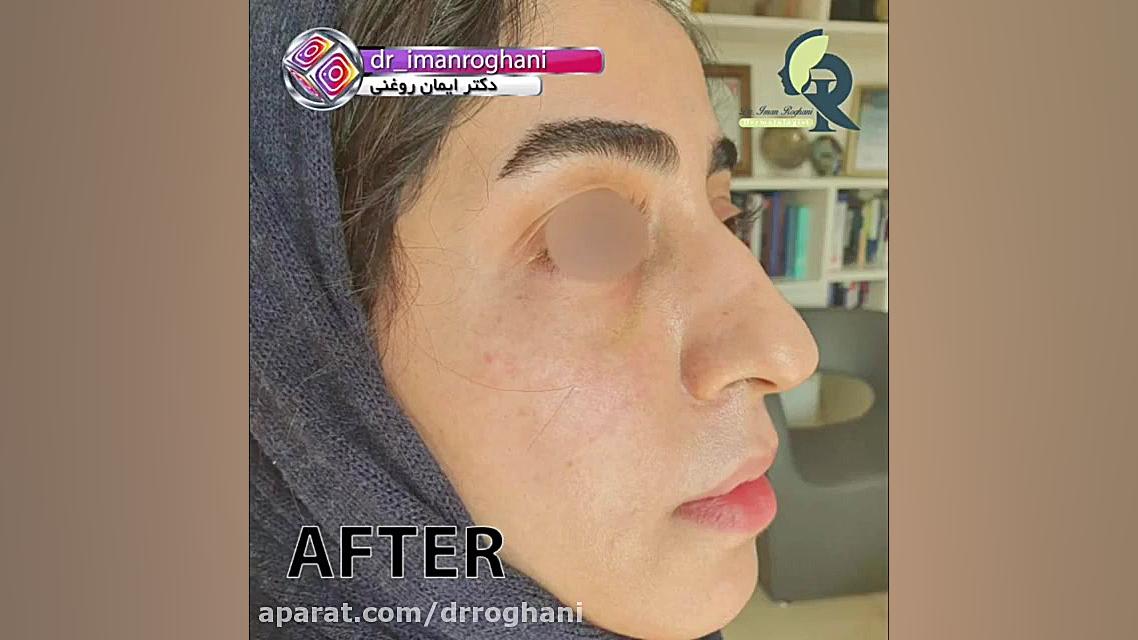 حجم دهی به صورت با تزریق چربی دکتر ایمان روغنی جراح و متخصص پوست و مو