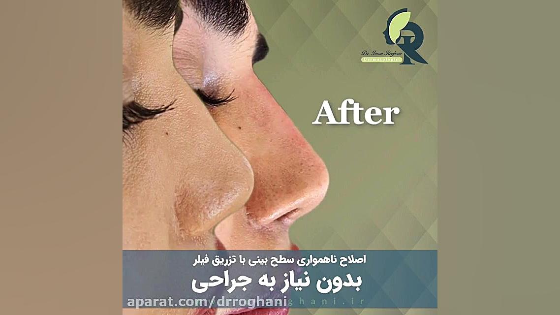 اصلاح فرم بینی بدون نیاز به جراحی دکتر ایمان روغنی جراح و متخصص پوست و مو