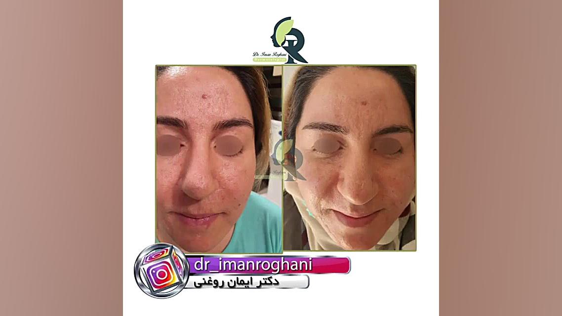 پیلینگ نقطه ای و سابسیژن دکتر ایمان روغنی جراح و متخصص پوست و مو