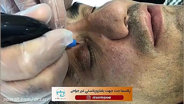 پلاسما جت جهت بلفاروپلاستی غیر جراحی هایپوفلکسی