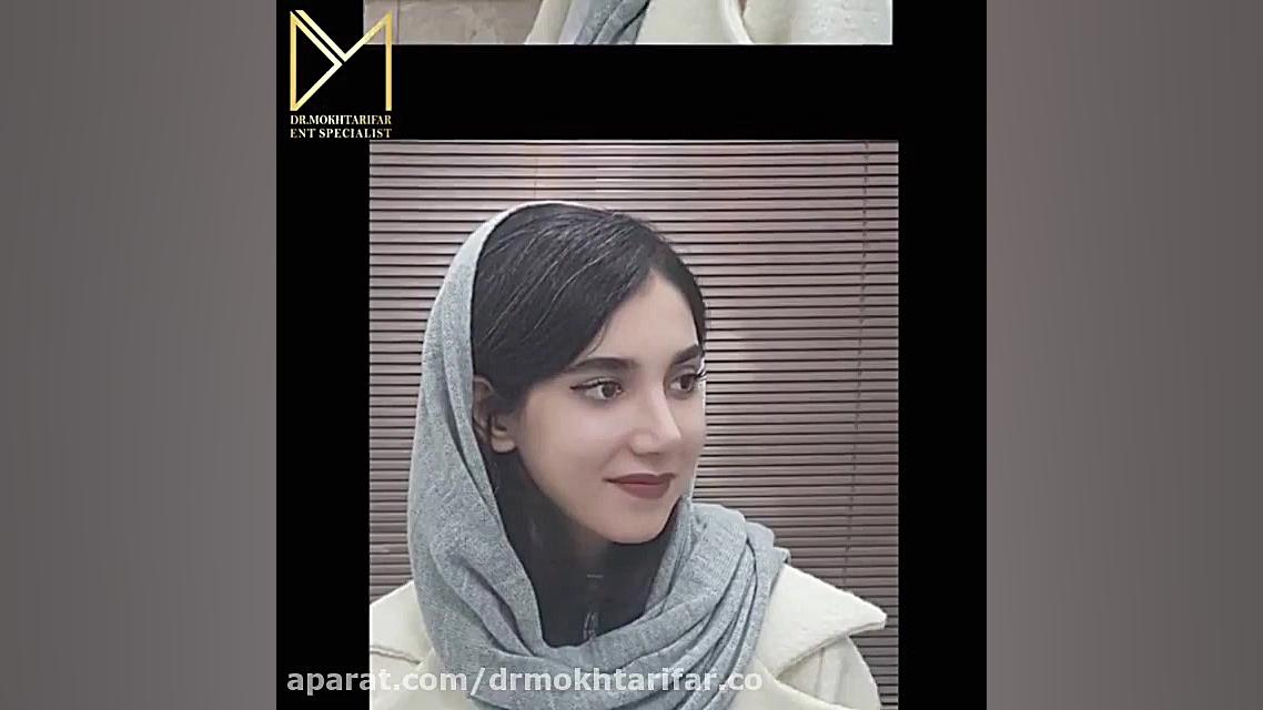 حدود یک ماه پس از جراحی زیبایی بینی به سبک نچرال استتیک دکتر فاطمه مختاری فر جراح بینی در لرستان
