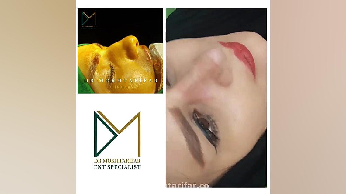 یک ماه پس از جراحی زیبایی بینی گوشتی با غضروفهای ضعیف دکتر فاطمه مختاری فر جراح بینی در لرستان