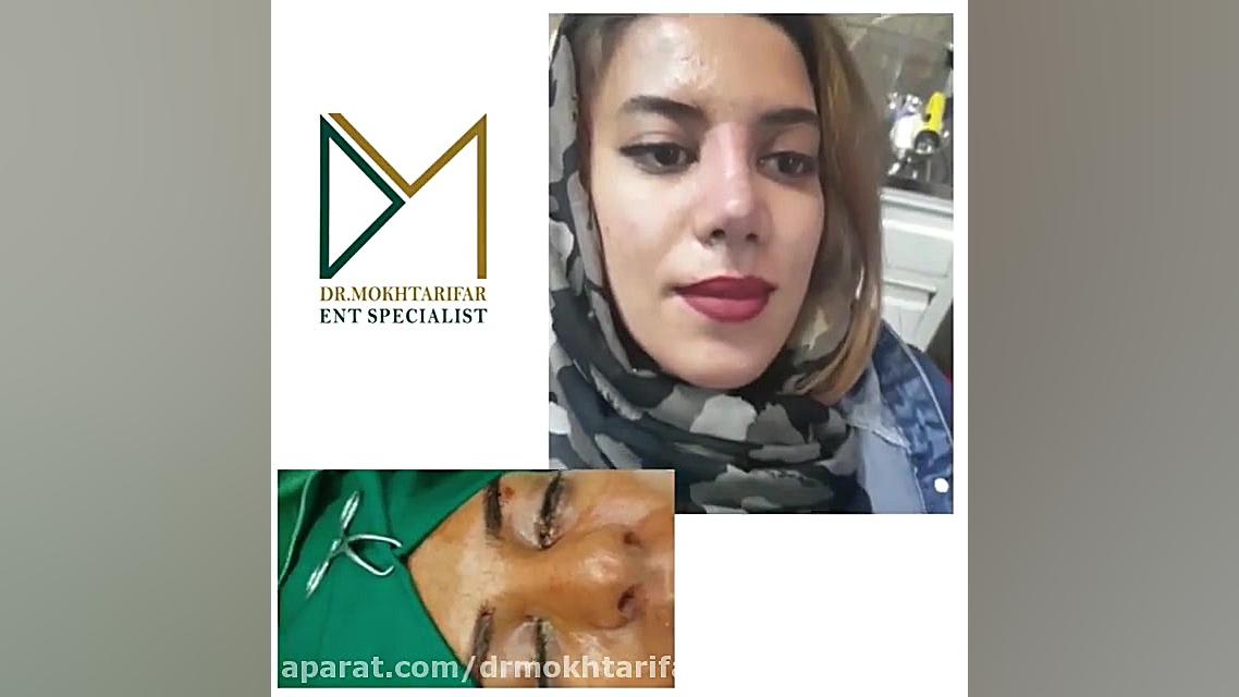 یک و نیم ماه پس از جراحی بینی با پوست ضخیم دکتر فاطمه مختاری فر جراح بینی در لرستان