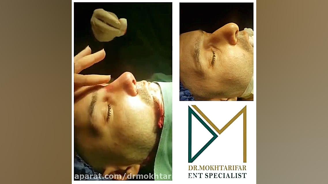 پایان جراحی زیبایی بینی در مراجعه کننده عزیزمون از شهر محلات استان مرکزی دکتر فاطمه مختاری فر جراح بینی در لرستان