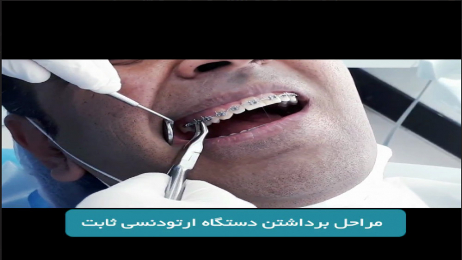 مراحل برداشتن دستگاه ارتودنسی ثابت FEV1