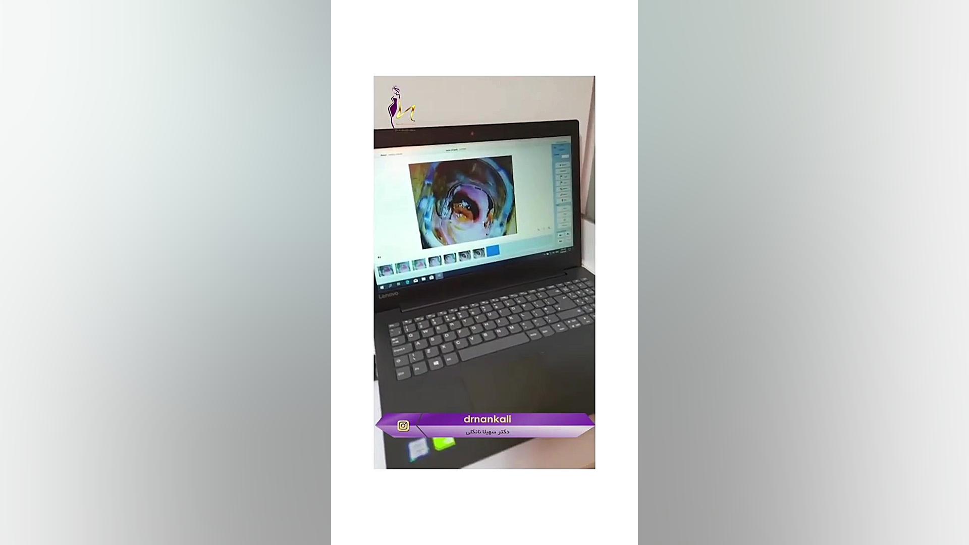 توضیحاتی در خصوص کاربرد کولپوسکوپی گوگوش