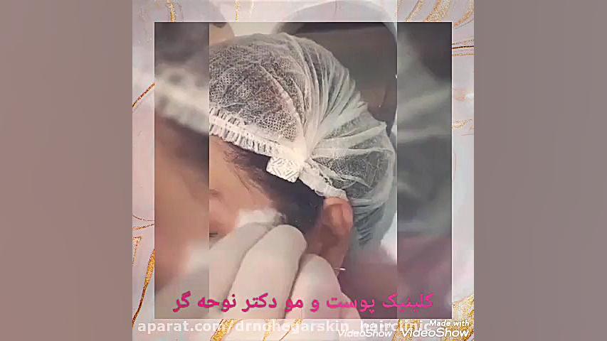 تزریق بوتاکس پیشانی کلینیک پوست و مو دکتر نوحه گر بهترین دکتر پوست ومو کرج 2021 کاندسارتان