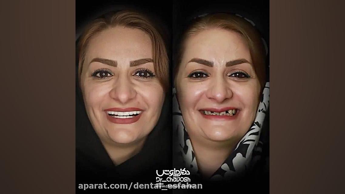 درمان ترکیبی ایمپلنت دندان ، روکش و لمینیت های تمام سرامیکی سندرم نفروتیک ارثی