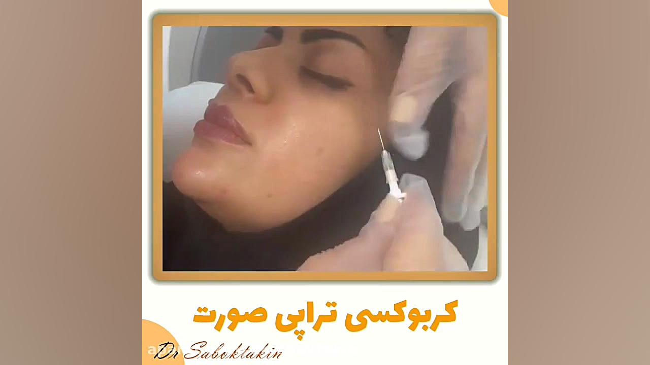 کربوکسی تراپی صورت در کلینیک دکتر سبکتکین متخصص پوست اصفهان متخصص پوست اصفهان دکتر مهدی سبکتکین