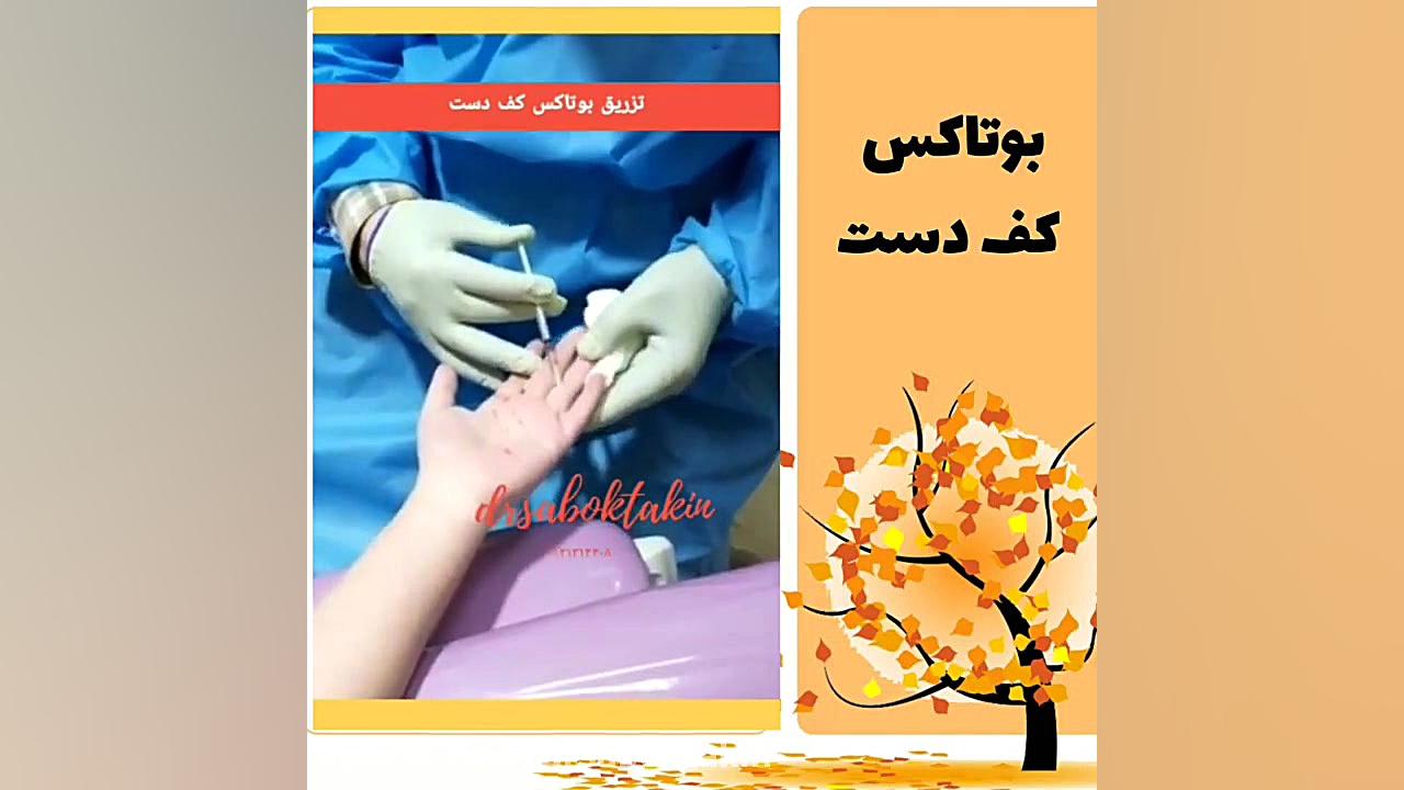 بوتاکس کف دست در کلینیک دکتر سبکتکین متخصص پوست اصفهان متخصص پوست اصفهان دکتر مهدی سبکتکین