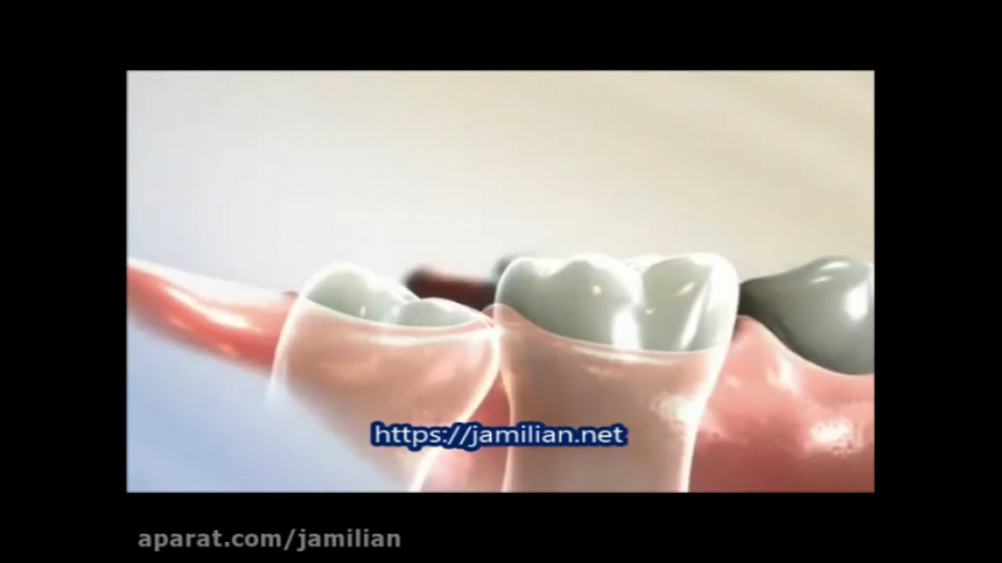 روش صاف کردن دندان عقل / متخصص ارتودنسی / دکتر جمیلیان دکتر عبدالرضا جمیلیان - متخصص ارتودنسی