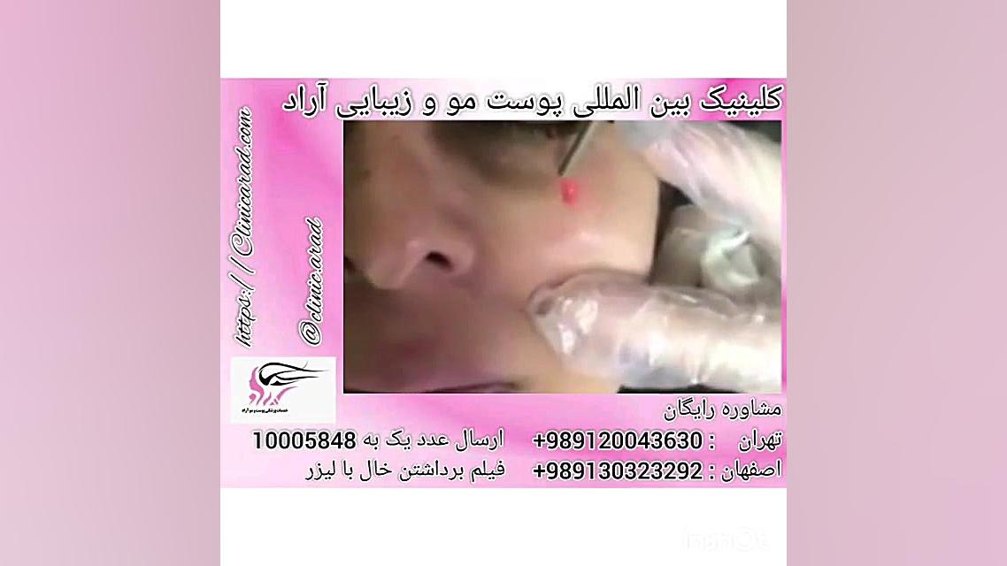 . فیلم برداشتن خال با لیزر جراحی زیبایی پلک