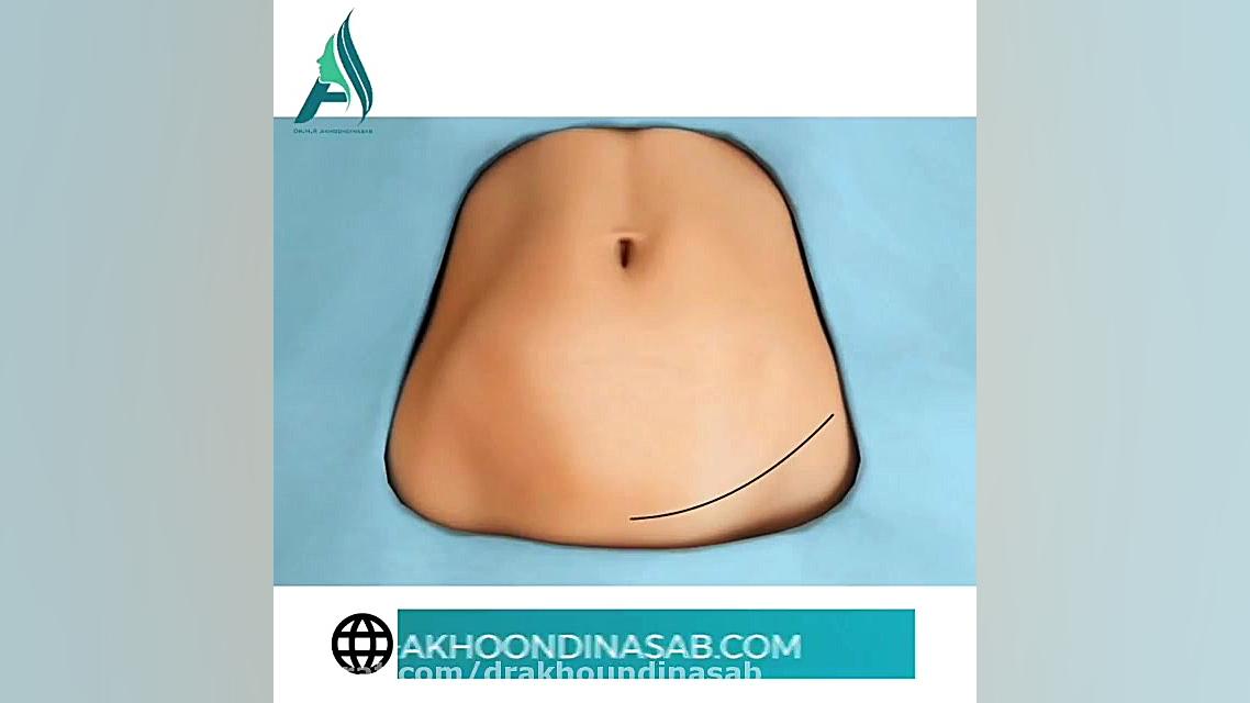 بارداری بعد از ابدومینوپلاستی دکتر محمدرضا آخوندی نسب-فوق تخصص جراحی پلاستیک