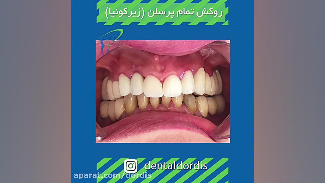 روکش دندان لیزر فرکشنال