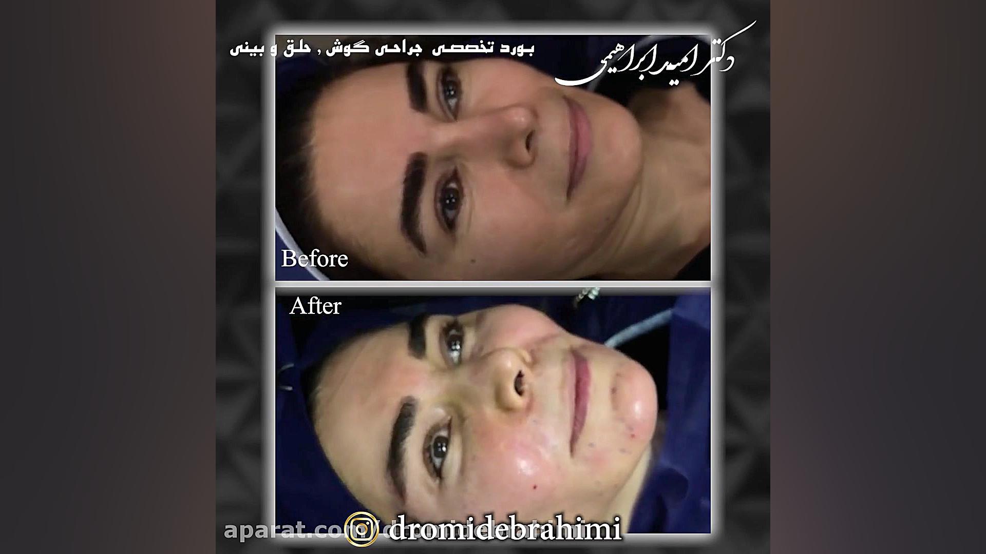 تزریق چربی به صورت توسط دکتر امید ابراهیمی دکتر امید ابراهیمی