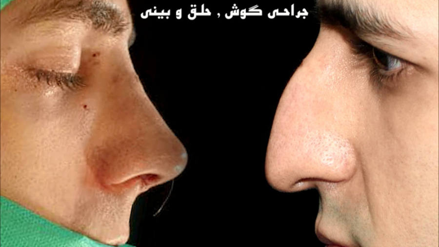 راینوپلاستی بینی قوزدار توسط دکتر امید ابراهیمی دکتر امید ابراهیمی