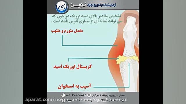آزمایش اوریک اسید خون آزمایشگاه پاتوبیولوژی نوین همدان