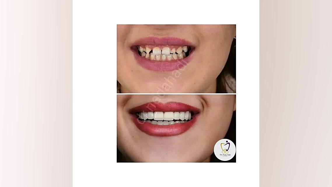 انجام کار زیبایی برای مراجعه کننده عزیز دکتر ندا هادی-دندانپزشک زیبایی