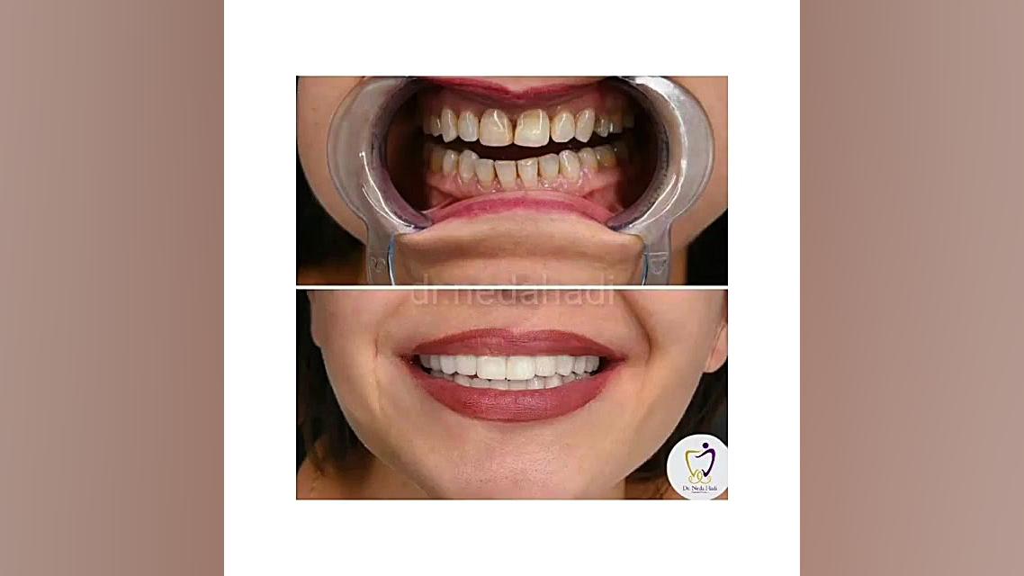 لبخند زیبا جوی عزیزمون دکتر ندا هادی-دندانپزشک زیبایی