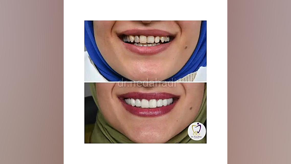 لبخند زیبای یکی دیگر از مراجعه کنندگان عزیزمون دکتر ندا هادی-دندانپزشک زیبایی