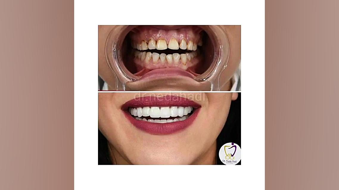 نمونه ای از دندانپزشکی زیبایی دکتر ندا هادی-دندانپزشک زیبایی