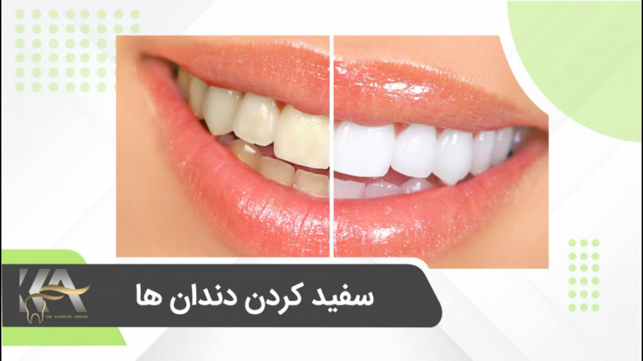 سفید کردن دندان ها دکتر کامیار عباسی متخصص ایمپلنت و زیبایی دکتر کامیار عباسی