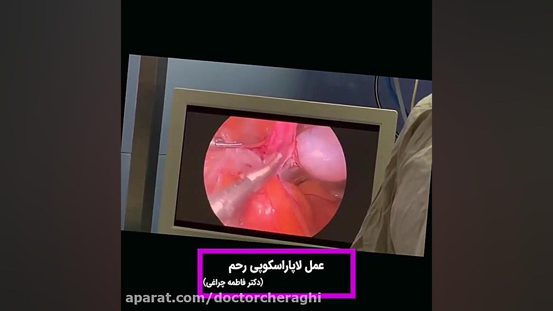 رضایتمندی بیمار عزیزمون از جراحی لاپاراسکوپی (رحم و تخمدان ) الناز شاکردوست