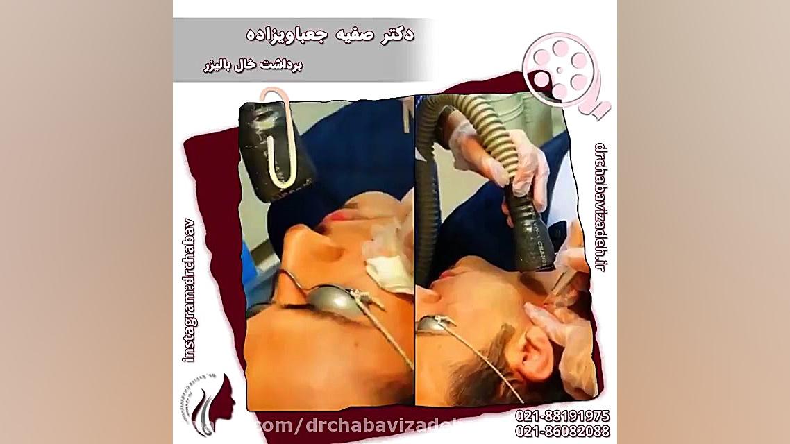 فیلم واقعی برداشتن خال با لیزر بدون درد و خونریزی دکتر صفیه چعباوی زاده