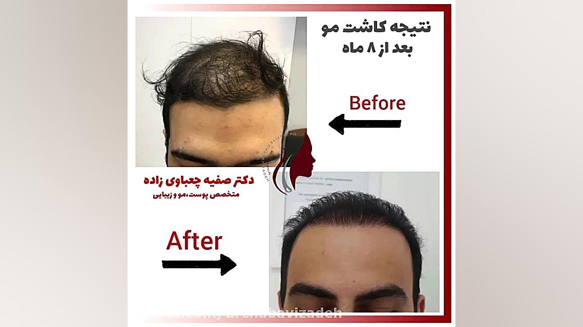 نتیجه کاشت مو بعد از 8 ماه دکتر صفیه چعباوی زاده