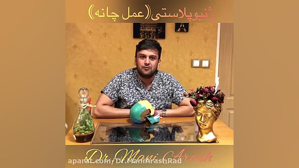 جراحی چانه یا ژنیوپلاستی دکتر مانی آرش راد جراح فك و صورت