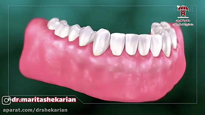 مراقبت های پس از جرمگیری دندان کودکان بیماری فیبری دیسپلازی