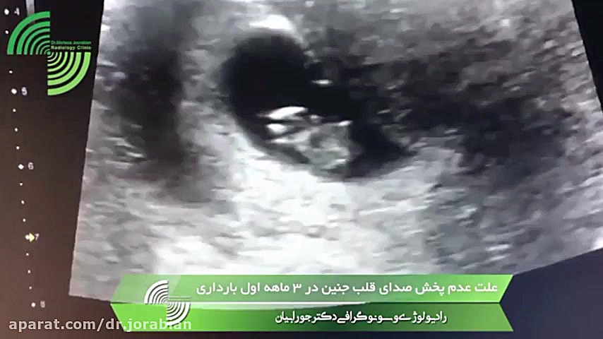 فیلم واقعی سونوگرافی و علت عدم صدای قلب جنین در 3 ماهه بارداری درمان جای جوش
