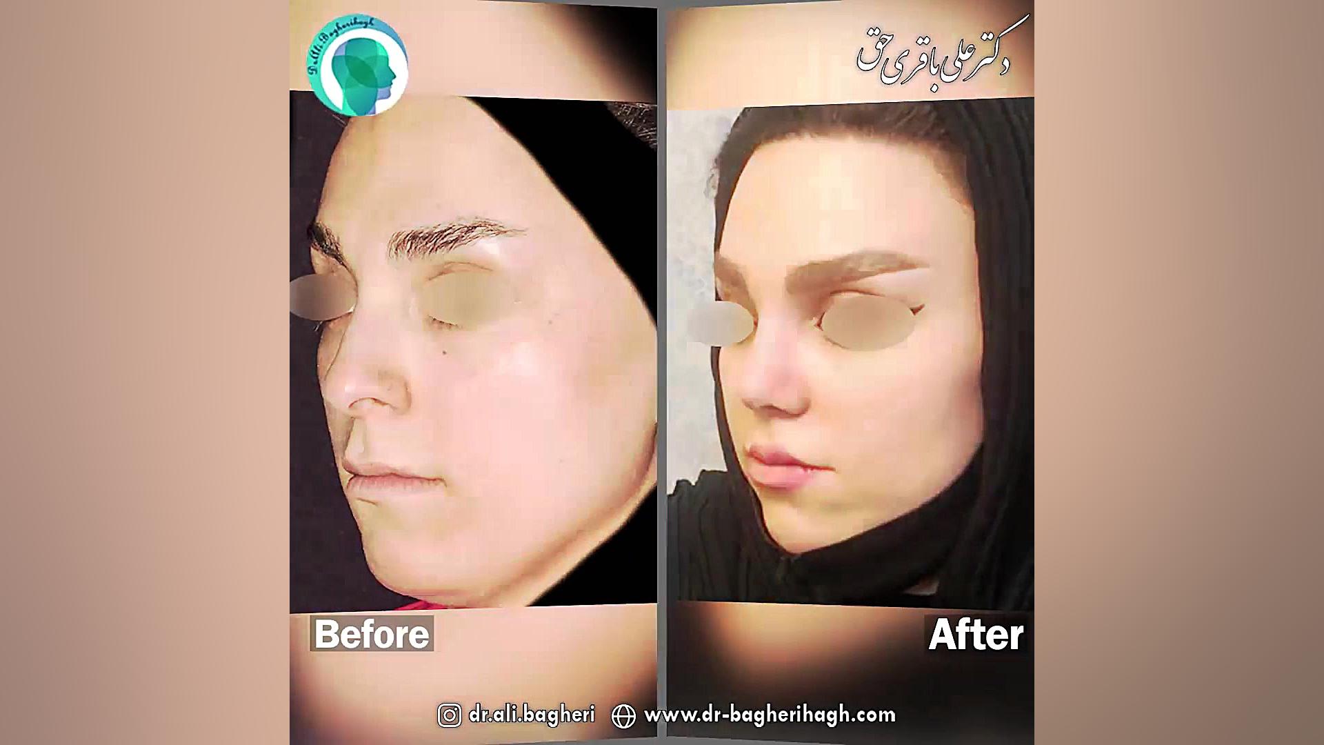قبل و بعد از جراحی بینی دکتر علی باقری حق