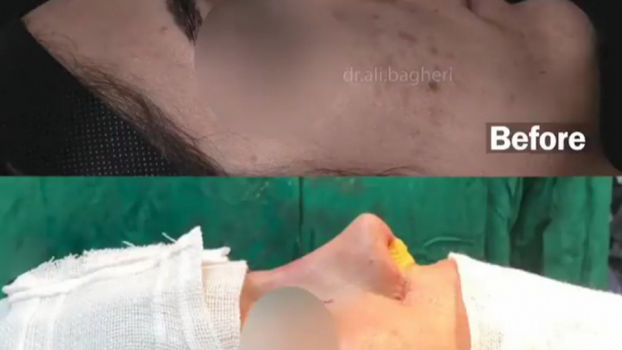 جراحی بینی توسط دکتر باقری حق دکتر علی باقری حق
