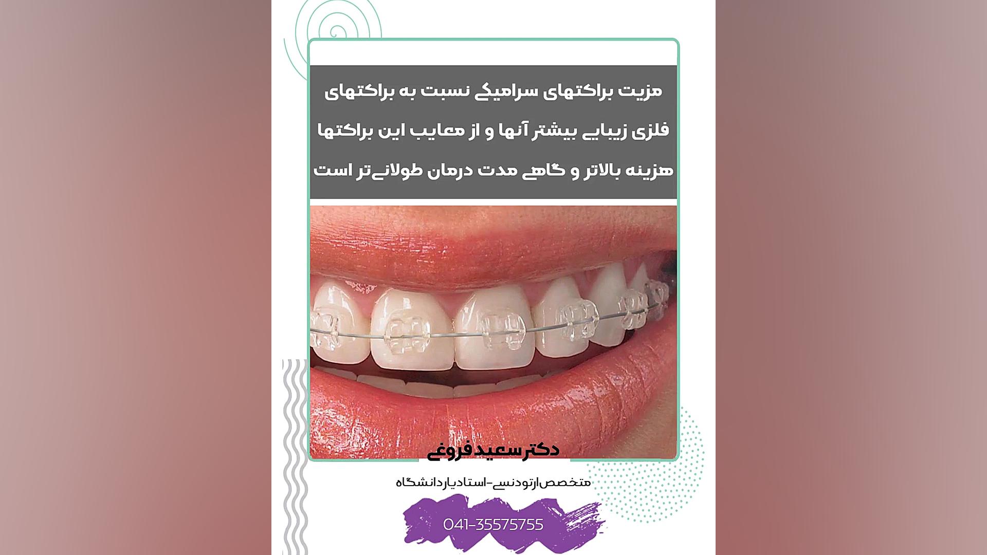ارتودنسی با براکت های سرامیکی دکتر سعید فروغی متخصص ارتودنسی