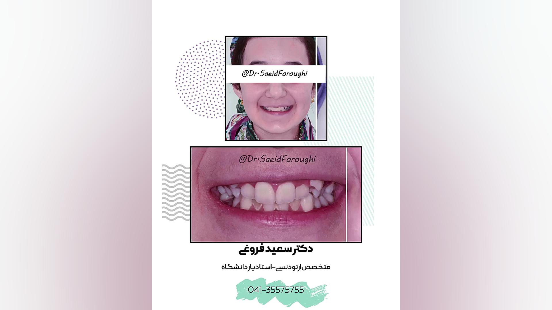 درمان بینظمی و کمبود شدید فضای دندانها توسط ارتودنسی ثابت دکتر سعید فروغی متخصص ارتودنسی