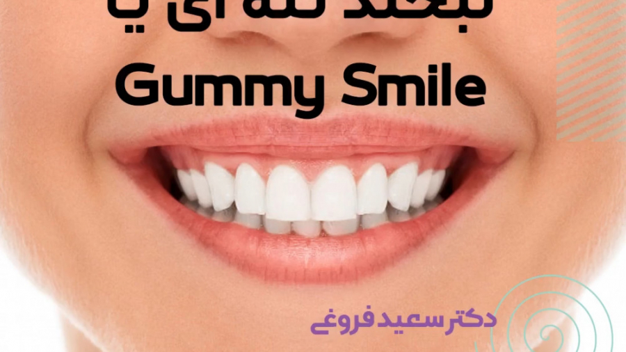لبخند لثه ای دکتر سعید فروغی متخصص ارتودنسی