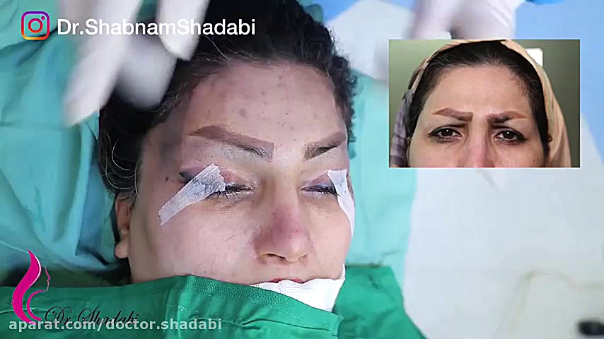فیلم لیفت ابرو توسط دکتر شبنم شادابی یا تمام جزئیات HIDA Scan