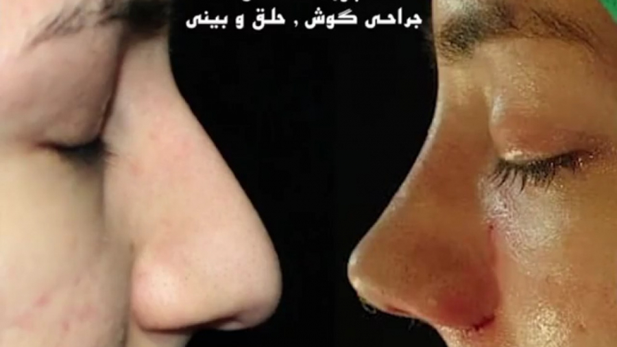 رینوپلاستی توسط دکتر امید ابراهیمی بهترین جراح بینی در تهران دکتر امید ابراهیمی