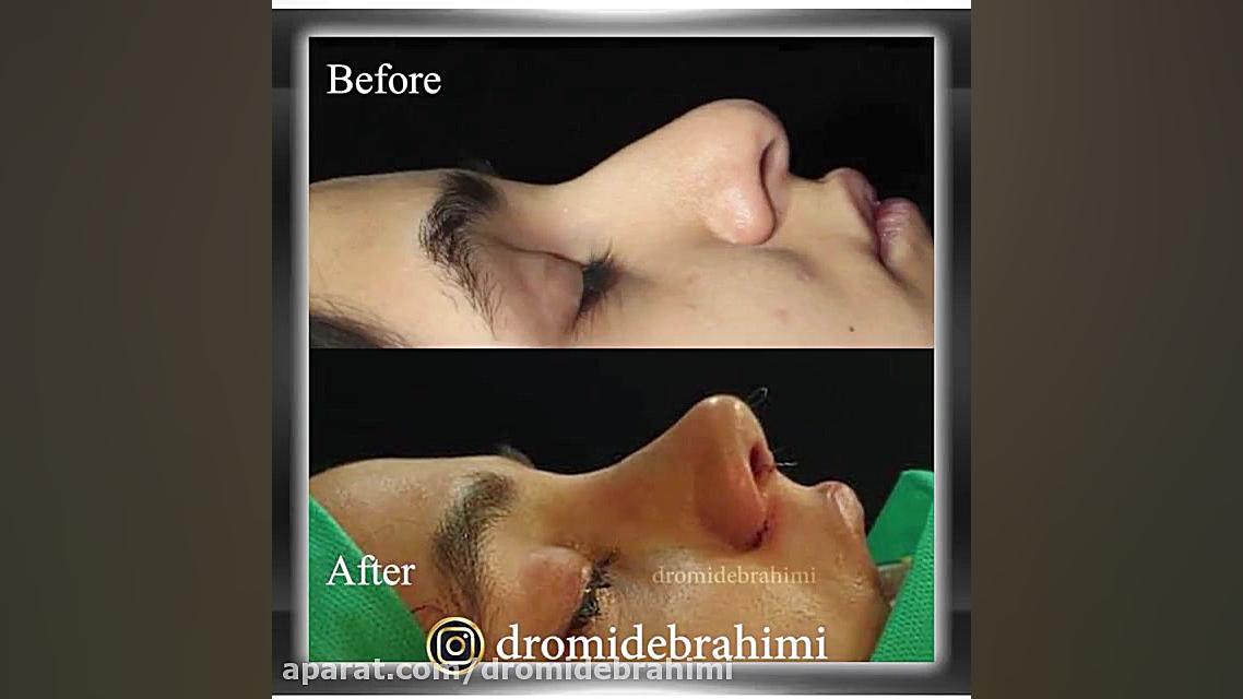 بلافاصله بعد از عمل بینی توسط دکتر امید ابراهیمی بهترین جراح بینی در تهران دکتر امید ابراهیمی